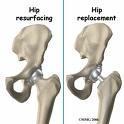 TOTAL HIP ARTHROPLASTY (Hip Replacement) Diagram of hip prosthesis Usually, bone cement is used to fix the prosthesis into the bone.