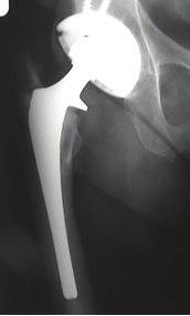 cartilage. When arthritis occurs this coating wears away.