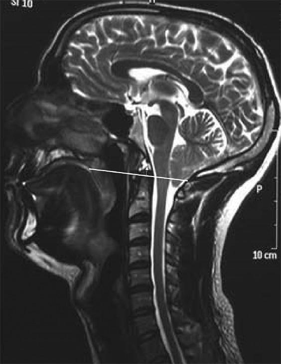 Figure 1: Chiari malformation patient. Solid line is the Chamberlain s line.