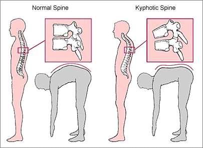 LORDOSIS is a swayback in the