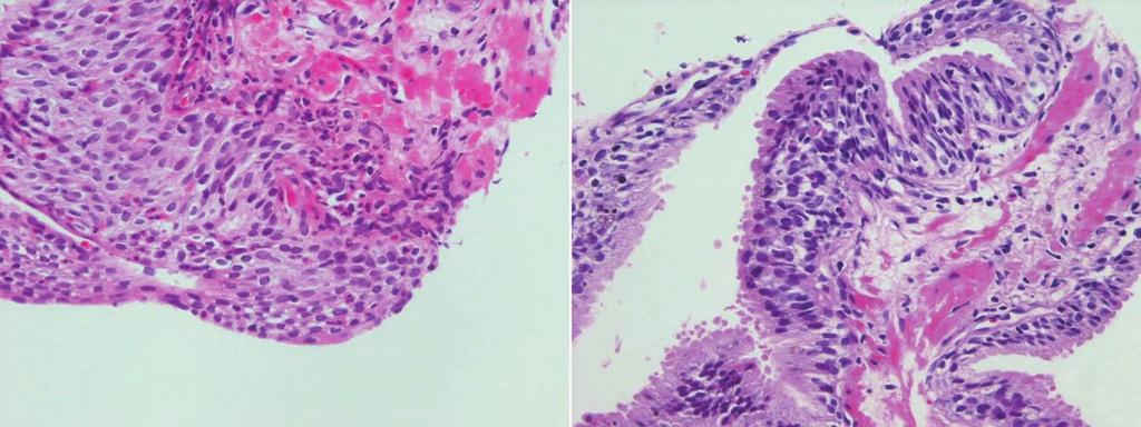 transitional cell metaplasia is characteristically found in the ductal epithelium.