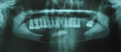 Intraoral examination showed an intact overlying mucosa with no sinus or discharge.