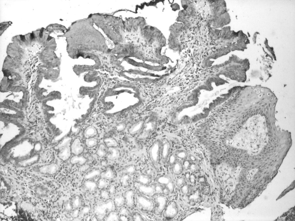 Annals of RSCB Vol. XV, Issue 2 Figura 2. Positive MUC5AC immunostaining in glandular Barrett epithelium.