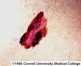 Characteristics of Pigment Cell Malignancy (Melanoma) New onset or recent change