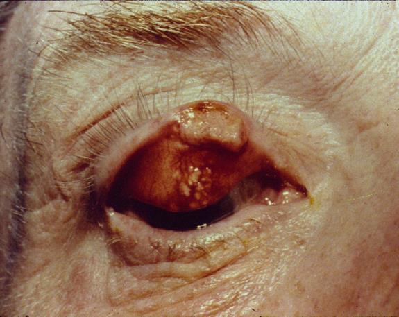 Sebaceous Gland Carcinoma Must r/o in any recurrent chalazion May be