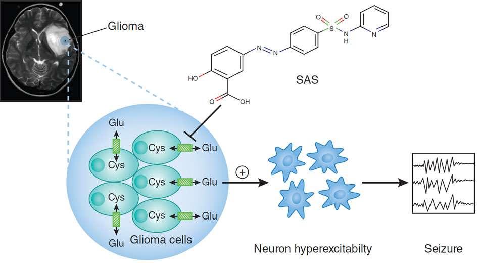 Glu release by glioma induces epileptic activity