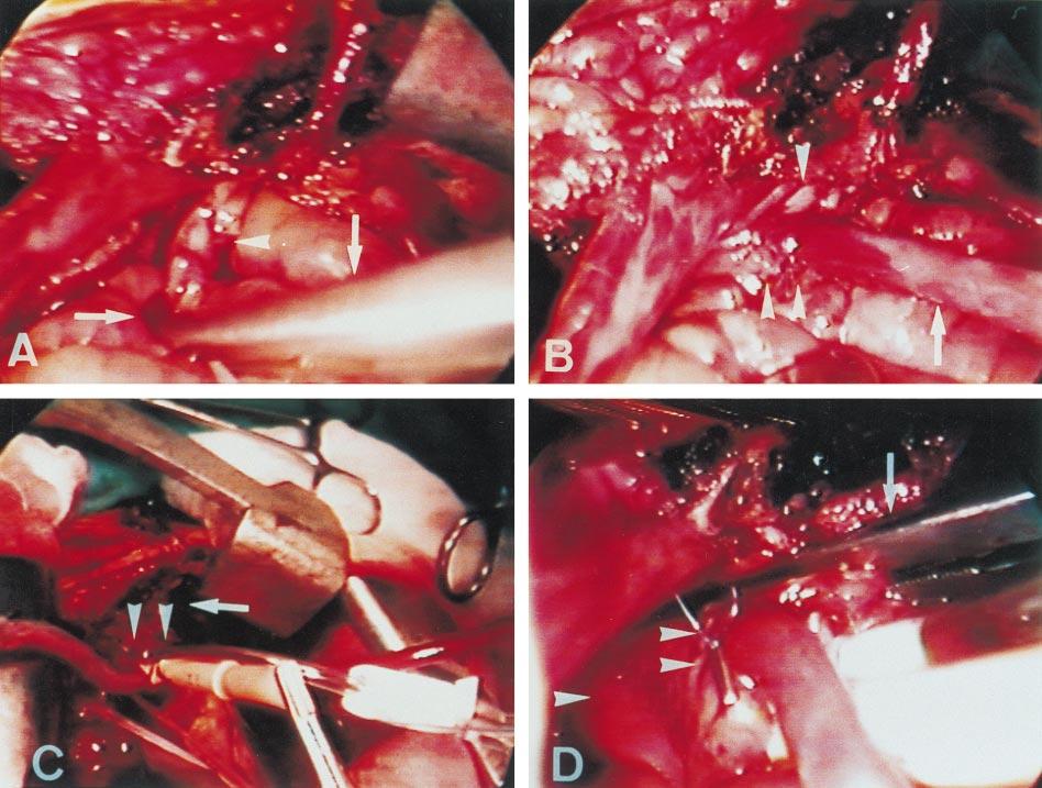 Ann Thorac Surg LIN ET AL 1998;65:407 12 MINIMAL ACCESS FOR CABG 409 Fig 2. Manipulation of the ascending aorta.
