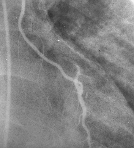 Ann Thorac Surg LIN ET AL 1998;65:407 12 MINIMAL ACCESS FOR CABG 411 Fig 4. Coronary angiography showing a patent left internal thoracic artery graft connected to the left anterior descending artery.