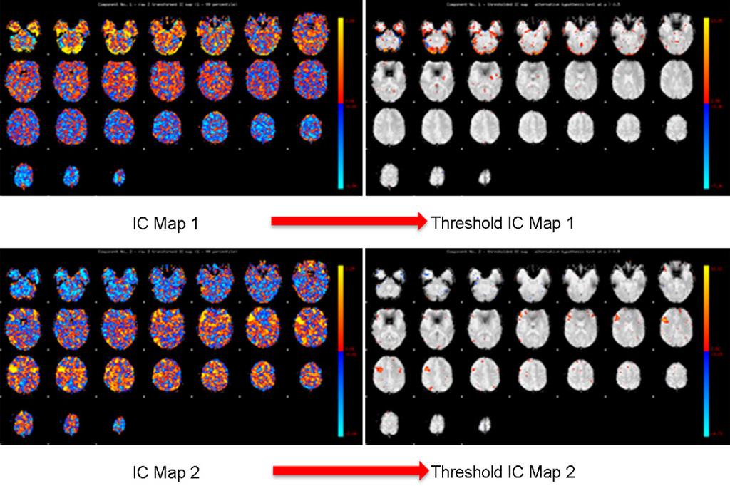 K. Li et al. / Computerized Medical Imaging and Graphics 33 (2009) 131 139 135 Fig. 4. Illustration for independent component (IC) maps thresholding.