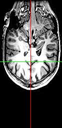 The Functional MRI (fmri): Magnetic Resonance Imaging Provides high