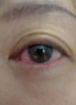 integrated eldercare course APPROACH AND MANAGEMENT OF ACUTE RED EYEs IN FAMILY PRACTICE IN SINGAPORE Dr Philemon Huang, Adj Asst Prof (Dr) Tan Ngiap Chuan SFP2011; 37(3): 54-59 INTRODUCTION Patients