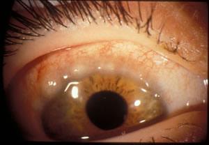 Clinical features: The main symptoms are: Intense ocular itching, Lacrimation, Photophobia, Foreign body sensation, Burning, Thick mucus discharge and Ptosis which is also occurs (it is a mechanical