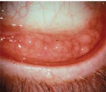 2- discharge: It is exudates filtered through conjunctival epithelium from dilated blood vessels with additional epithelial debris, mucus and aqueous tear.