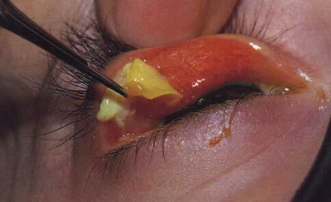 - Atopic conjunctivitis. - Prolonged use of topical medications.
