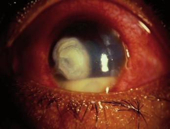 Allergic conjunctivitis Acute atopic conjunctivitis is an IgEmediated allergic response precipitated by airborne allergens such as dust, pollen, spores and animal dander.