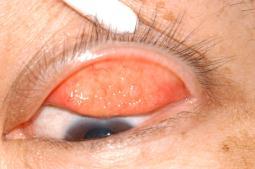 Seasonal Allergic Conjunctivitis clinical signs Bilateral Conjunctival injection Chemosis Watery discharge Giant papillary