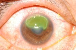 Exposed sutured and prostheses Mild mucous discharge Vernal Allergic Conjunctivitis clinical signs Bilateral Giant papillary