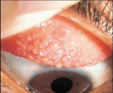 Giant Papillary Conjunctivitis clinical signs Papillary hypertrophy of superior tarsal conjunctiva Mucoid discharge Papillae with white fibrotic centers can be seen in patients with long-standing