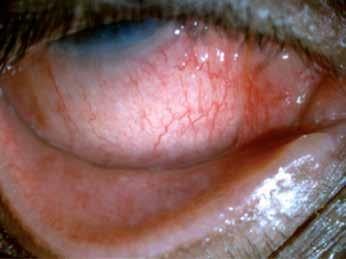 Bacterial conjunctivitis Acute bacterial conjunctivitis Acute bacterial conjunctivitis is a very common ocular condition which is primarily due to the Staphylococcus, Haemophilus and Streptococcus