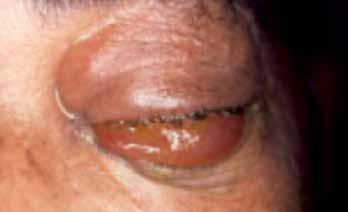Initially, acute bacterial conjunctivitis presents unilaterally. The second eye is often affected soon thereafter.