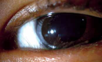 Adult inclusion conjunctivitis This is a sexually transmitted infection that typically affects young, sexually active adults.