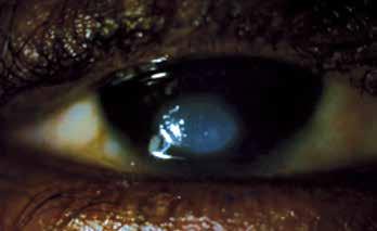 central corneal ulcers follow a breach in this layer, secondary to either trauma or pre-existing ocular surface disease.