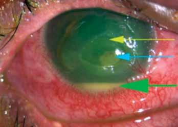 Figure 9: Vernal keratoconjunctivitis: shield ulcer consequence of persistent eye rubbing. Traditionally, this condition is classified as either a palpebral, limbal or mixed type.