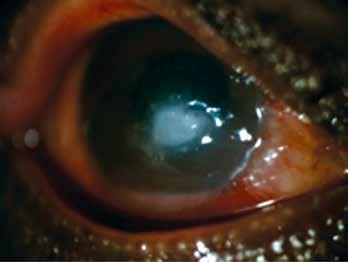 Local predisposing factors include trauma, especially with vegetable or organic matter, contact lenses and topical steroids. Usually, fungal ulcers are much less aggressive than bacterial ulcers.