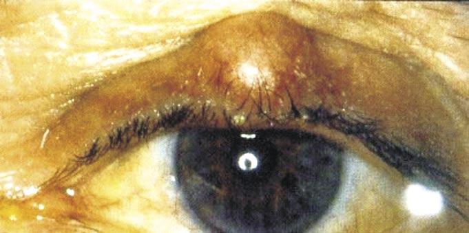 Primary eye care for the general practitioner Thunström V, FCOOphth(SA) Department of Ophthalmology, Nelson R Mandela School of Medicine, University of KwaZulu-Natal Correspondence to: Dr V
