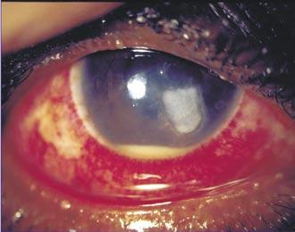 The eye typically has a watery discharge, conjunctival injection and mild lid swelling, with a swollen ipsilateral pre-auricular lymph node.