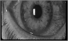 common infectious keratitis presenting on emergent basis 62% caused