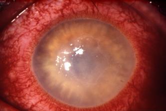 The RED EYE and ALLERGIC EYE DISEASE DIAGNOSIS & MANAGEMENT Frank Larkin Moorfields Eye Hospital RED EYES conjunctivitis keratitis