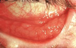 location of redness episcleritis? clarity of cornea and iris detail keratitis? stain cornea with fluorescein ulcer?