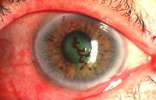 papillary or follicular inflammation IS THIS CONJUNCTIVITIS BACTERIAL? Rietveld et al.