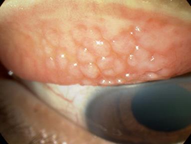 chemosis corneal ulcer if severe symptoms