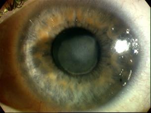 CORNEAL INFECTION CORNEAL INFECTION: Herpes simplex Pain, watering, photophobia History of cold