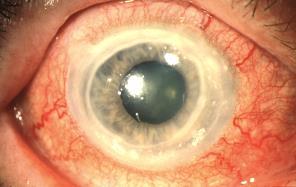 vision often affected focal or diffuse hyperaemia, bluish tinge SCLERITIS ocular complications