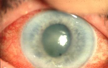 ANGLE CLOSURE GLAUCOMA examination vision severely reduced intense redness hazy cornea and poor iris detail fixed oval and mid-dilated pupil RED EYE Special situations contact lens wear: infection if