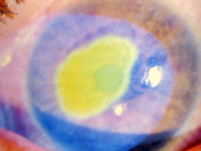 Ophthalmology Corneal Abrasion - Usually clear history of very recent trauma - Foreign Body Sensation - Pain +++ - Lacrimation - Photophobia Fig.