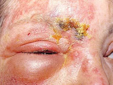 Shingles - Vesicular rash on face/scalp - swelling around the eye - If eye involved, photophobia, blurry vision. Fig.