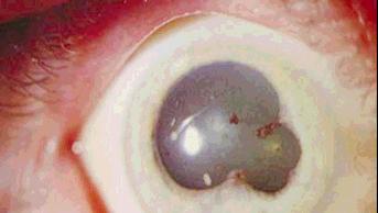 24 Keratic Precipitates - Photophobia - ± Blurred vision - Slight watering - Unequal pupils (distorted due to previous