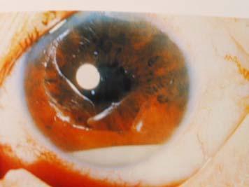 Orbital Cellulitis - Recent sinusitis - Painful, swollen eye - Malaise, fever Fig.
