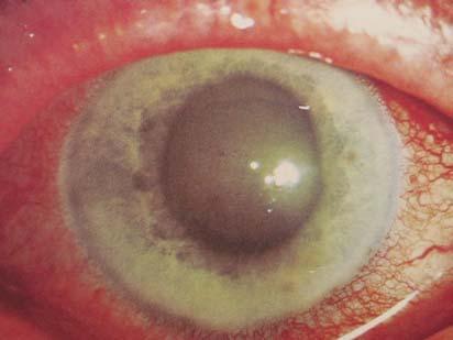 Acute Glaucoma - Painful loss of vision - Common in Long-sighted patients, oriental races higher risk.
