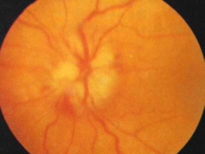 31 Central retinal artery occlusion Sudden Loss of Vision (without preceding ocular upset) 1) Central retinal artery occlusion (Fig.
