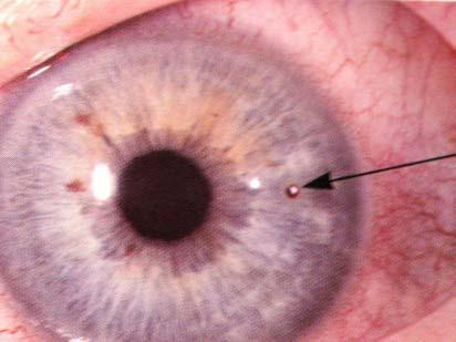 Corneal Foreign Body - Always clear -!!Beware of high velocity FB, eg. Hammering, Grinding, Strimming.