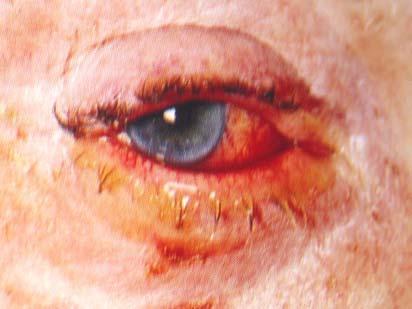 - Viral / Bacterial / Allergic - Gritty sensation in affected eye - Mucopurulent / watery discharge - ± Lashes stuck together on waking - Conjunctival