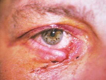 Welding Flash / Arc Eye - Welding without protective goggles / Sun bed. - symptoms similar but more severe than corneal abrasion - Proxymetacaine 0.
