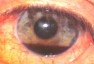 Rupture of the iris sphincter muscle may be visible as irregularity of