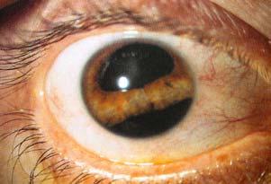 Hyphaema Damage to the iris blood vessels causes haemorrhage into the