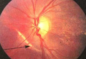 10 Hyphaema Iridodialysis Tearing of the root of the iris from the
